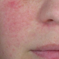 Rode vlekken in het gezicht: rosacea of couperose?