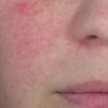 Rode vlekken in het gezicht: rosacea of couperose?