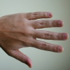 Pijn in de knokkels en de vingerkootjes: oorzaken en behandeling